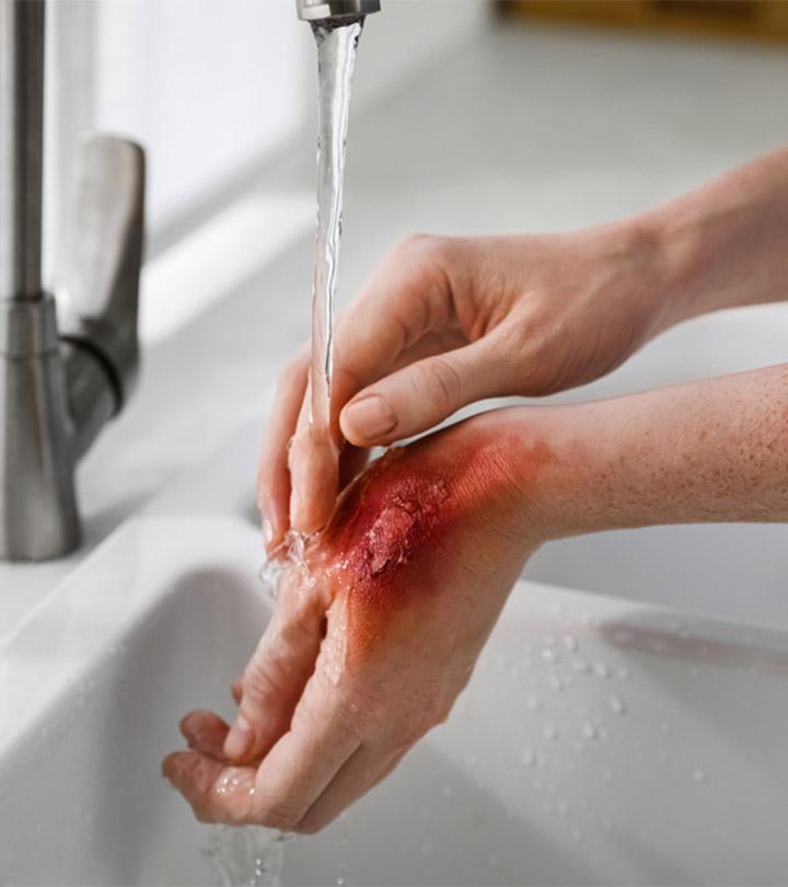 what causes chemical burns and how to treat them